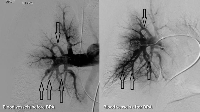 balloon angioplasty for chronic pulmonary hypertension Cleveland Clinic