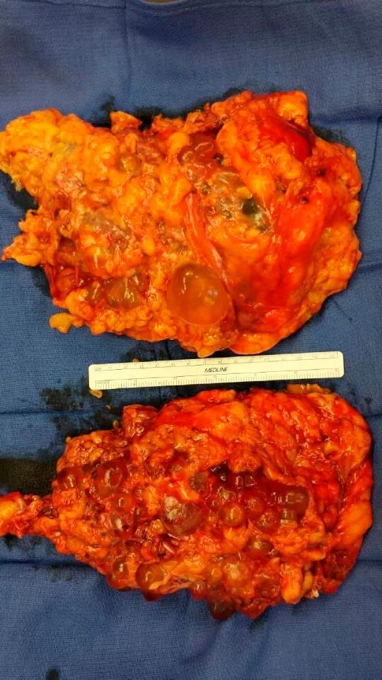 Consult QD Bilateral Nephrectomy #1