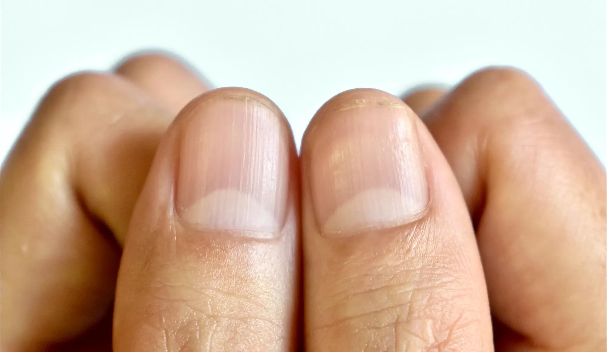 Half-Moon Nails (Lunulae): What They Mean