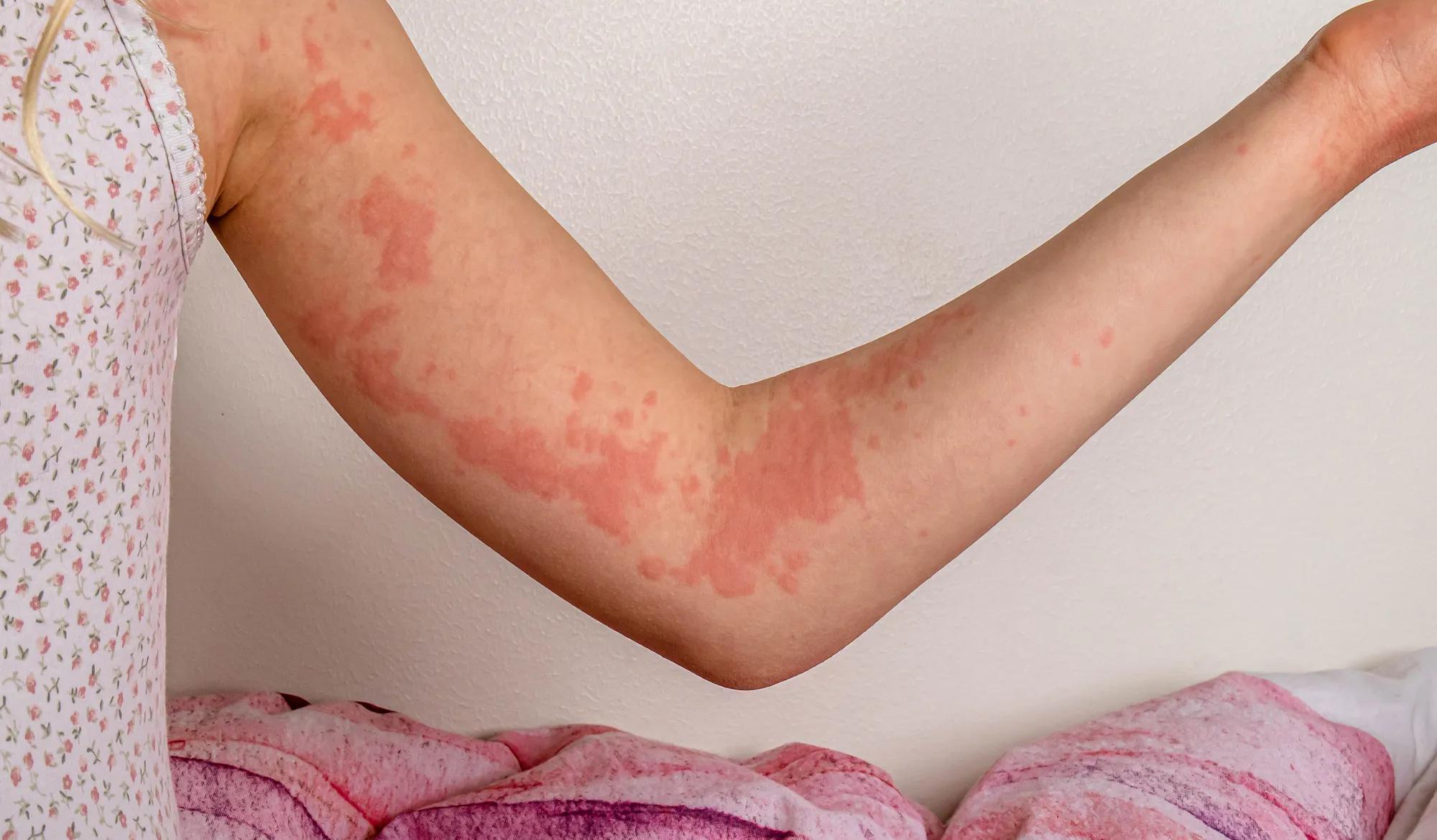 Chronic Hives and Diet Is There a Connection