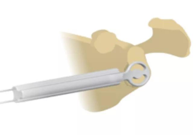 Guided instrumentation and parallel pin placement.