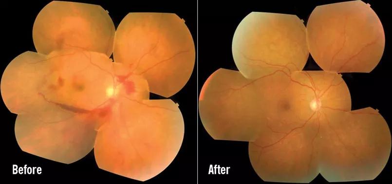 Diabetic retinopathy