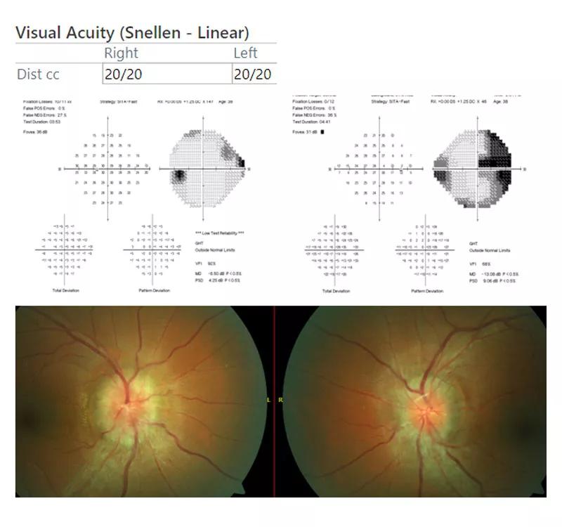 Changes In Fulminant Idiopathic Intracranial Hypertension