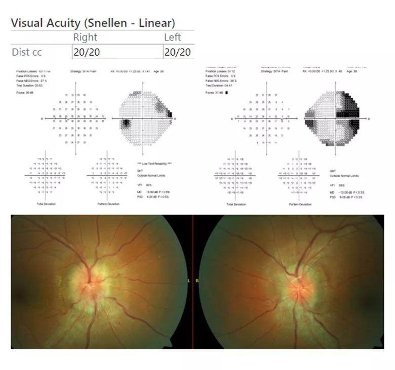 Visual field test and fundus photography of patient with IIH