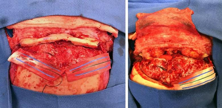 Extended bifrontal craniotomy is the removal of the orbital bar