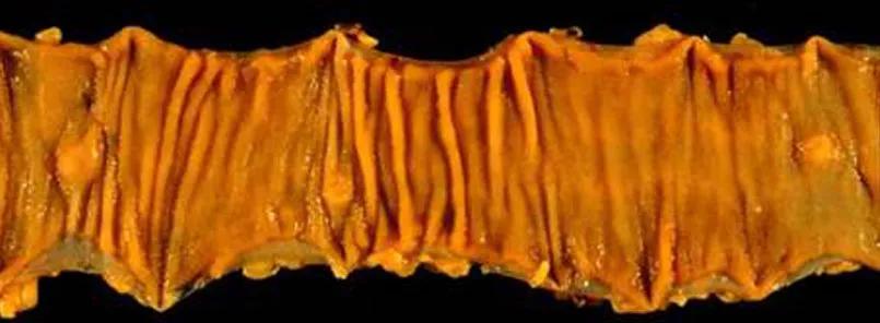 Small bowel carcinoid tumor