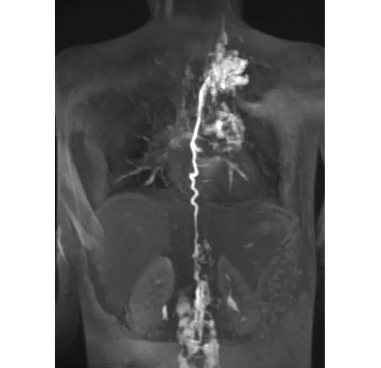 MR lymphangiogram showing collateralization of obstructed lymphatic vessels
