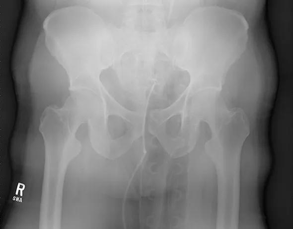 Figure 2. Anteroposterior pelvis view after binder application