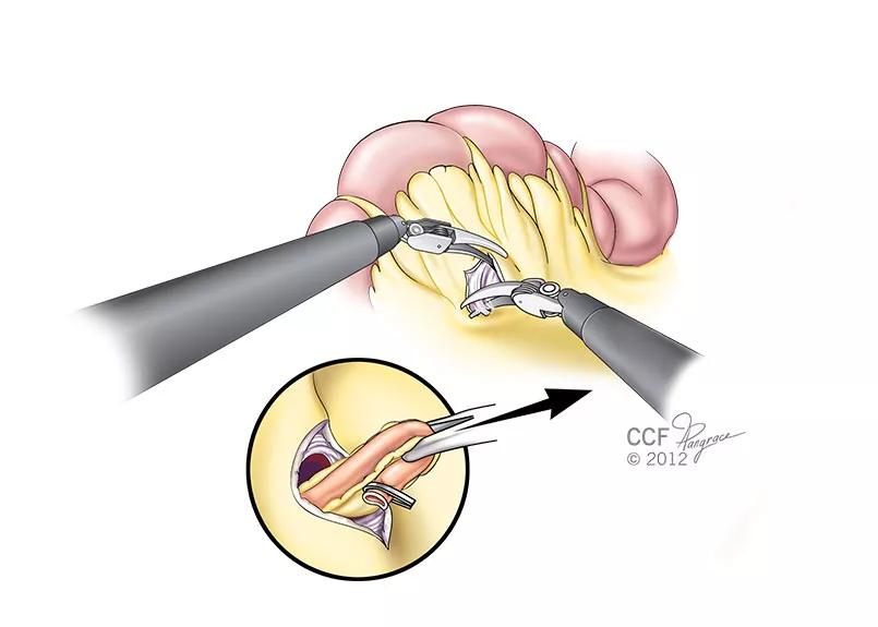 Inset-1-ILEAL-CONDUIT_pull_12-76737