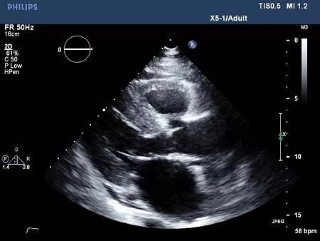 Echocardiogram of the case patient