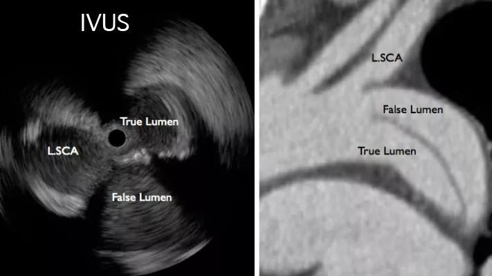 Figure 3. Intravascular ultrasound confirmed the wires were in the true lumen.