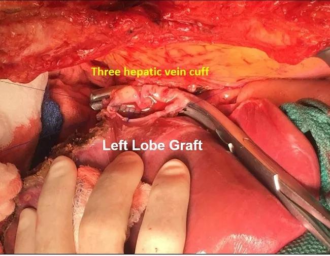 The completed three-vein venous cuff is anastomosed to a venoplastied hepatic vein of the left-lobe graft