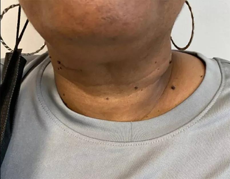Decreased throat swelling