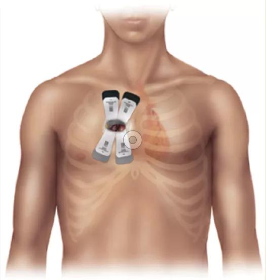 Isolated Aortic Valve Replacement