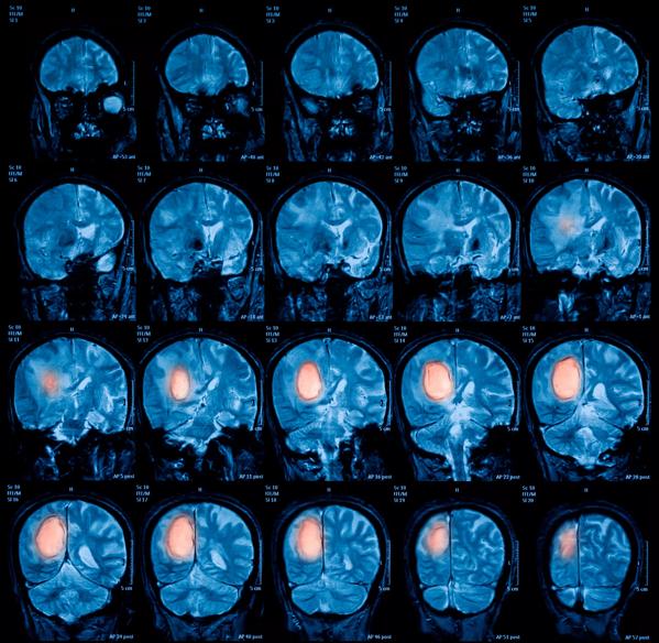 Magnetic resonance imaging (MRI) of the brain, brain tumor