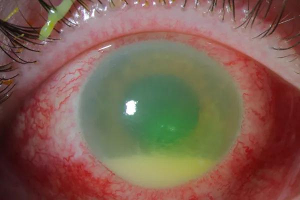 4 mm hypopyon detected in the anterior chamber paracentesis.