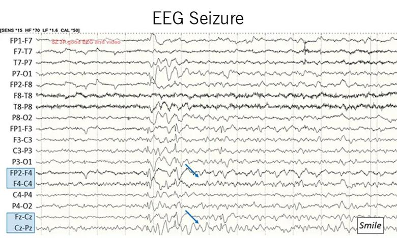 EEG recording showing a seizure