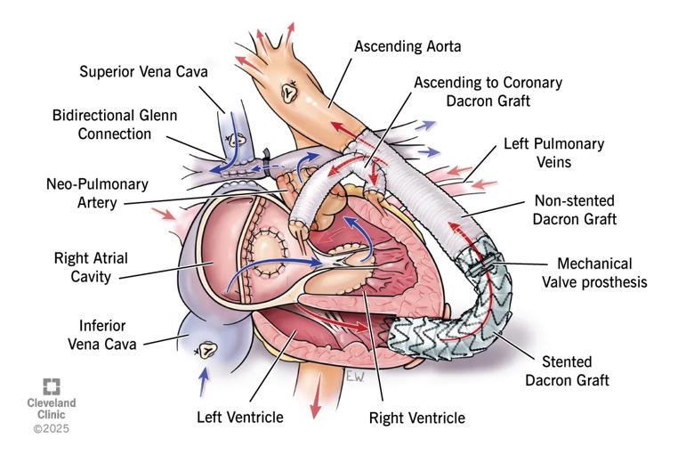 Illustration of postoperative anatomy 