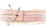 Enterotomy construction.