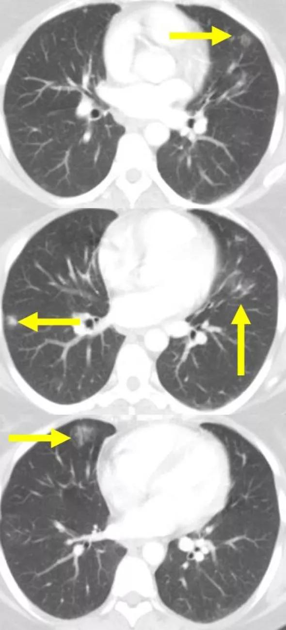 Figure 1. Chest CTs at presentation show ground-glass opacification and interstitial thickening in both lungs. Atelectasis or scarring is present in the right middle lobe.