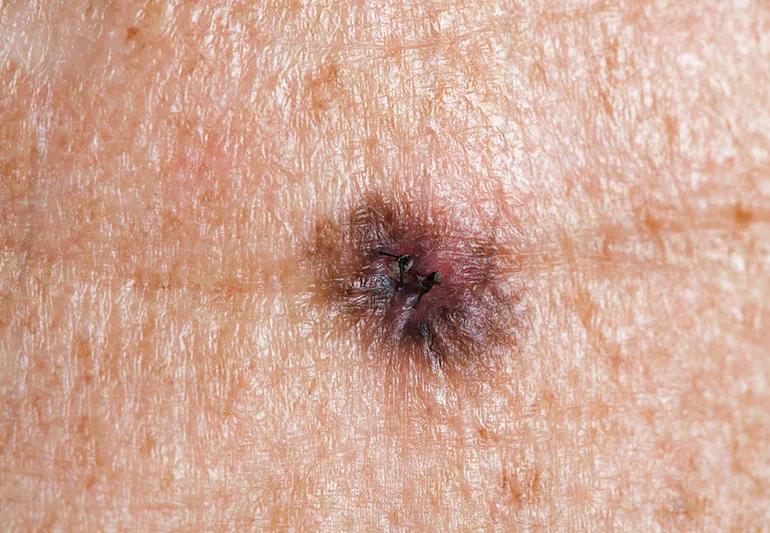How To Tell if a Mole Is Cancerous 8 Signs