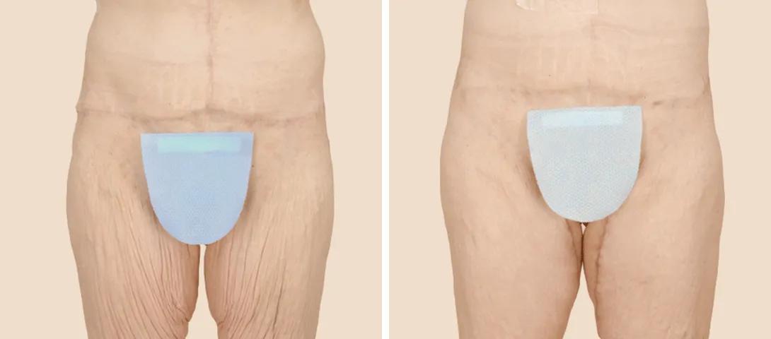 Before circumferential abdominoplasty (left) and after (right).