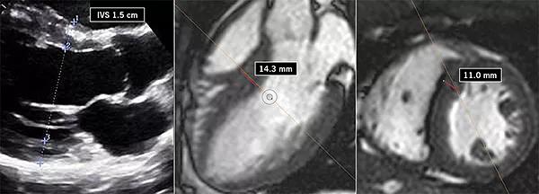 Series of three echo and MRI images from page 3 of Summer Cardiac Consult 