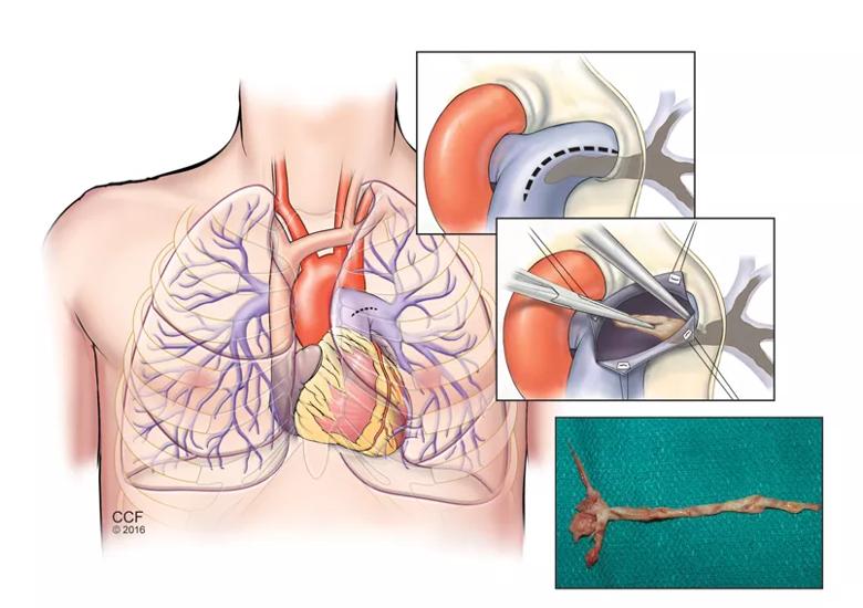 Pulmonary thromboendarterectomy for CTEPH 
