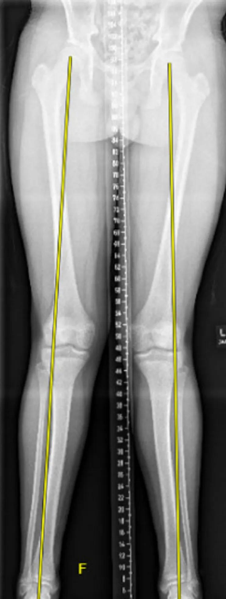 X-ray of patient with genu valgum