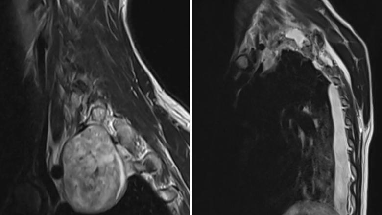 7 cm schwannoma at the intersection of the spine, lung and major arteries