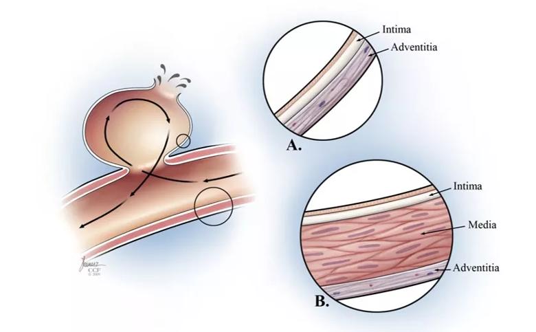 cerebral blood vessel layers in the context of intracranial aneurysm