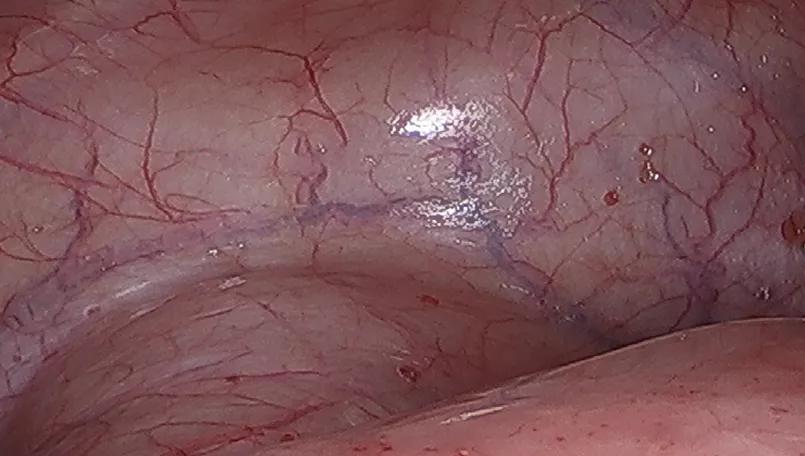 Papillary red lesions were scattered throughout the anterior compartment of the pelvis.