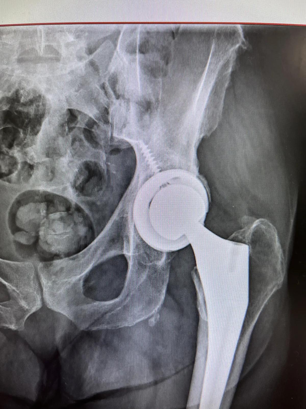 X-ray of failed hip replacement