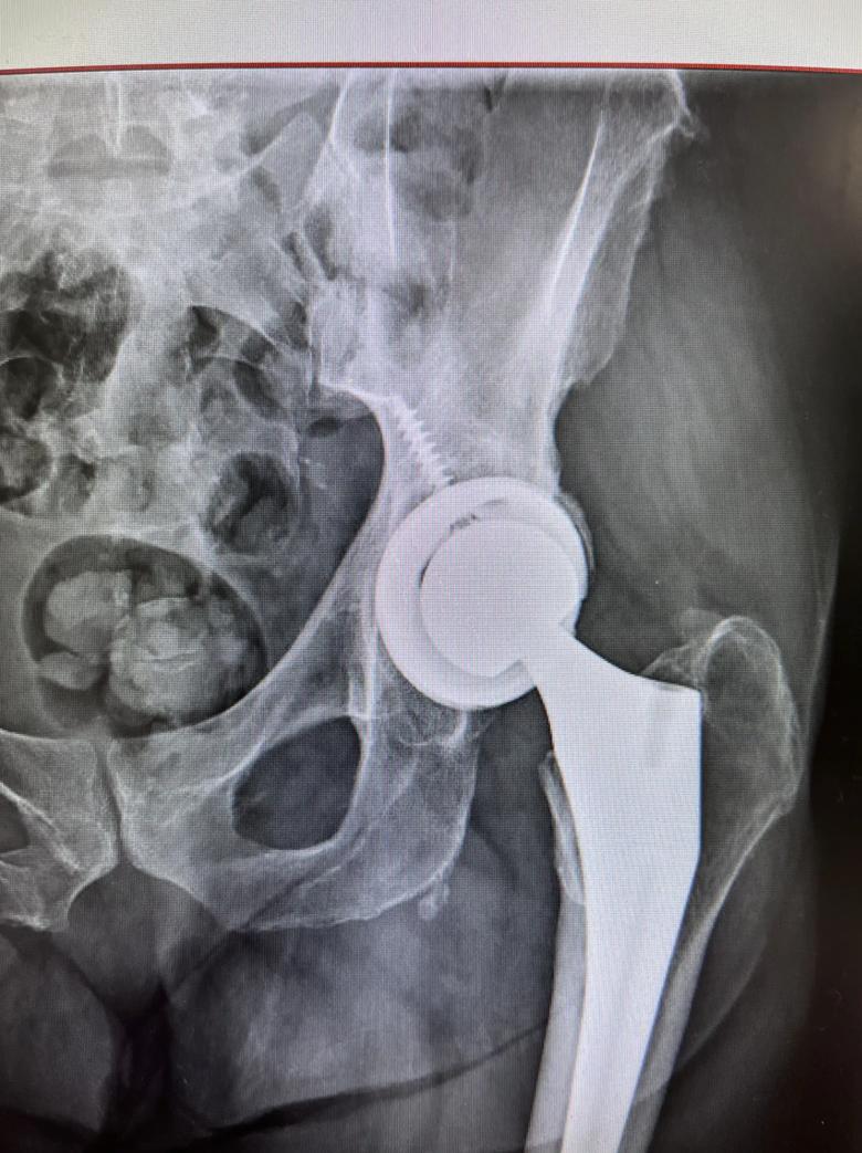 X-ray of failed hip replacement
