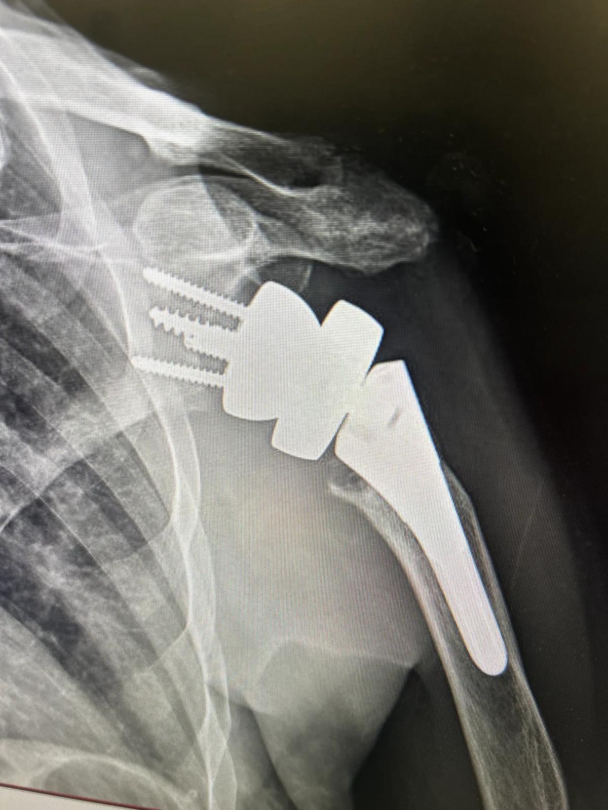 X-ray of shoulder implant