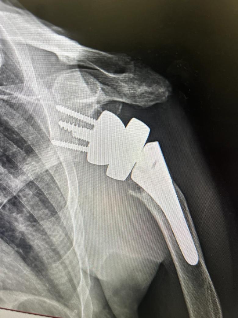 X-ray of shoulder implant