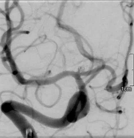 brain aneurysm after treatment with coiling procedure