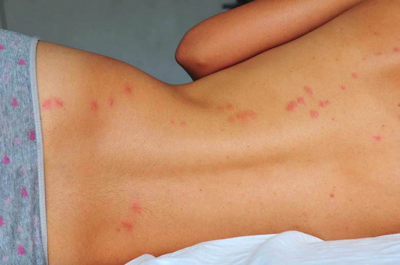 a person lying on their side, showing multiple bed bug bites on their back