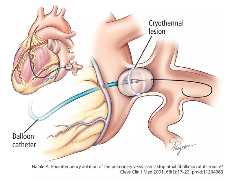 Balloon catheter lodged in pulmonary vein