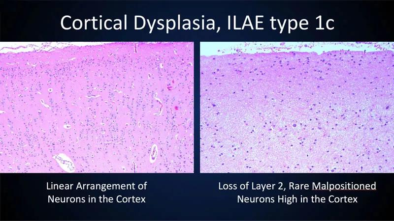 histopathology showing cortical dysplasia in an infant