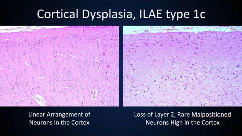 histopathology showing cortical dysplasia in an infant