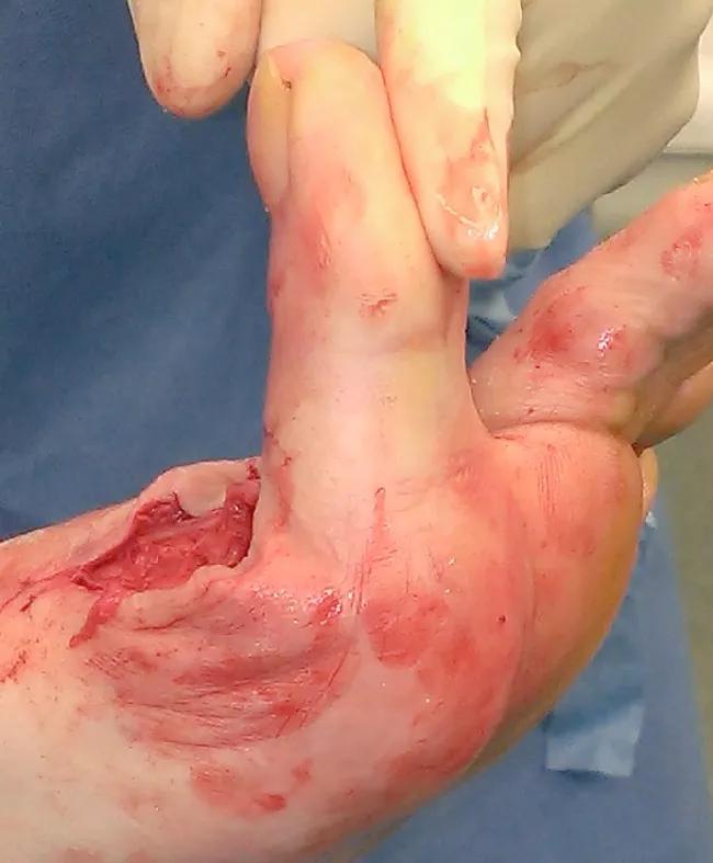 Figure 2. Post-cheilectomy, increased range of motion of the first MPJ is visualized.