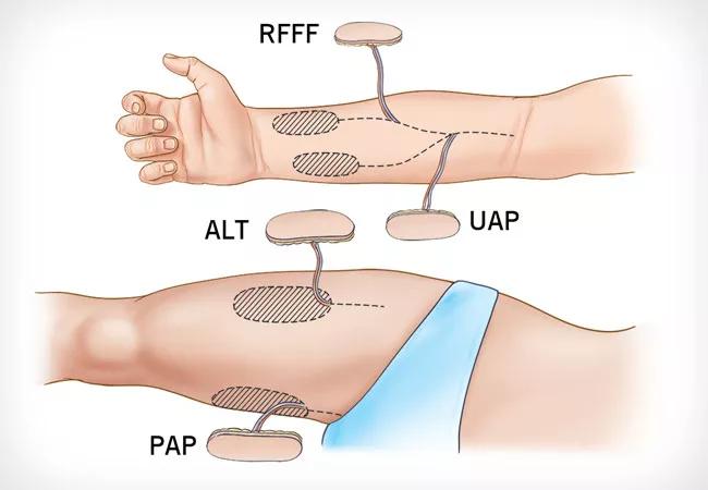 Consider Different Free Flap Donor Sites for Head and Neck Reconstruction