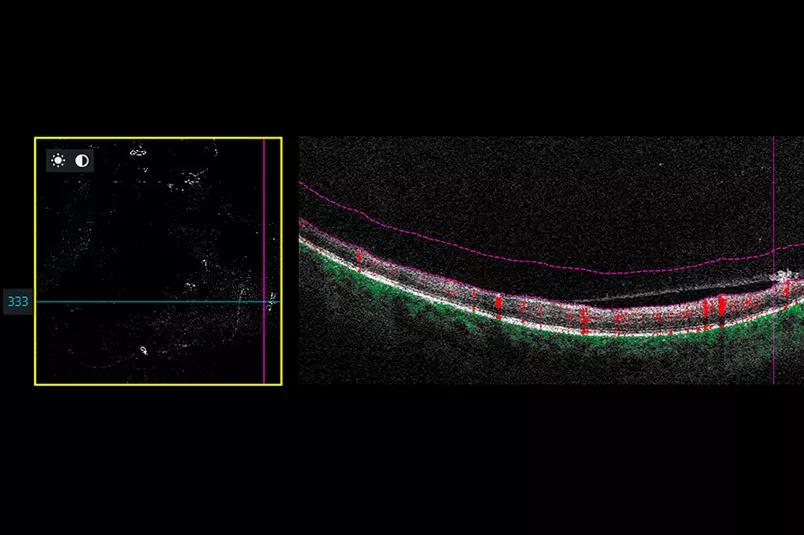 B-scan image revealing neovascular lesion