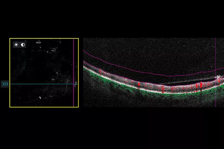 B-scan image revealing neovascular lesion