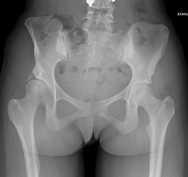 X-ray of pelvis