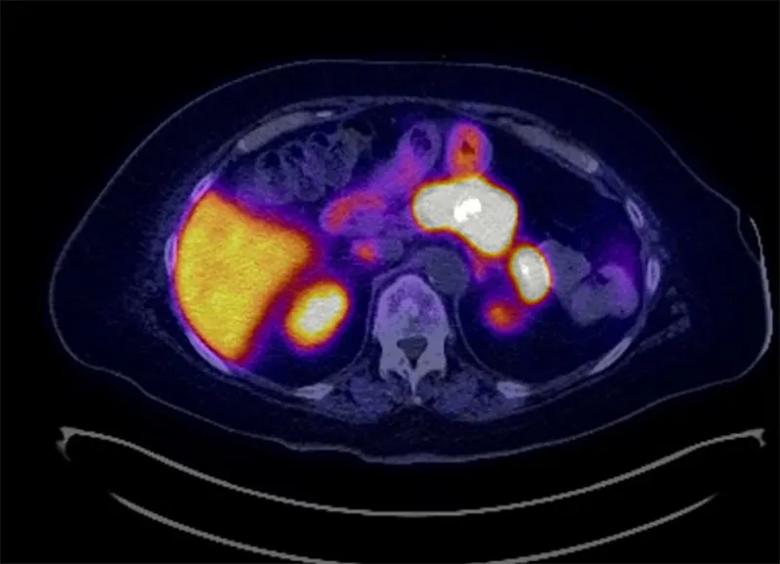MRI of an insulinoma