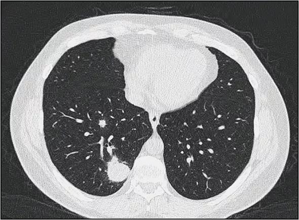 Abatacept-CT_Fig-Bottom_Langford_590pxl-width
