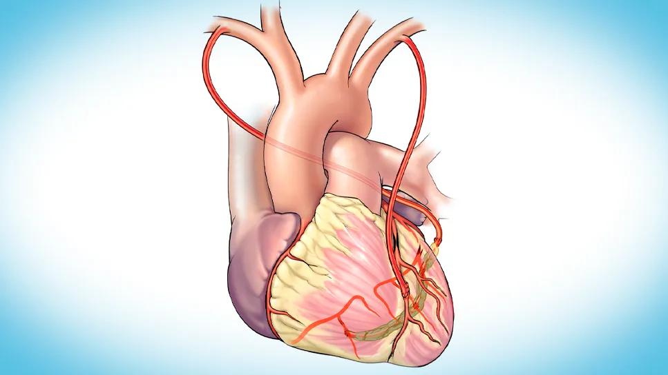 Saphenous Vein Graft For Cabg