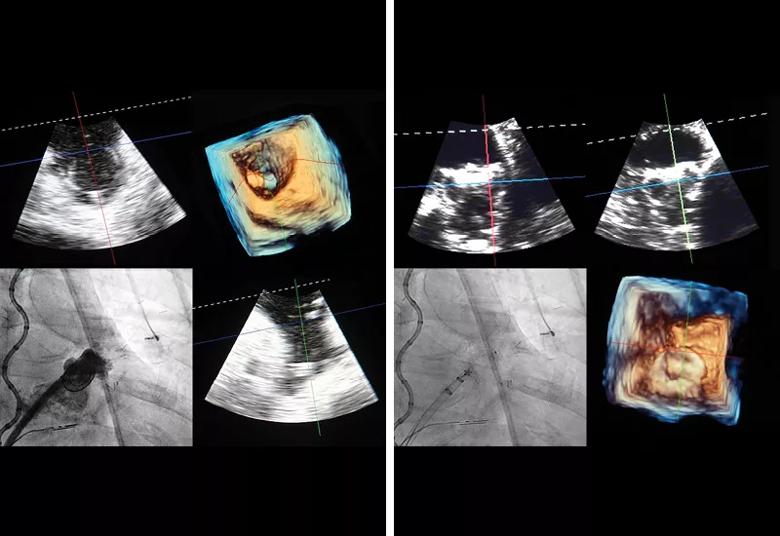 images showing left atrial appendage occlusion